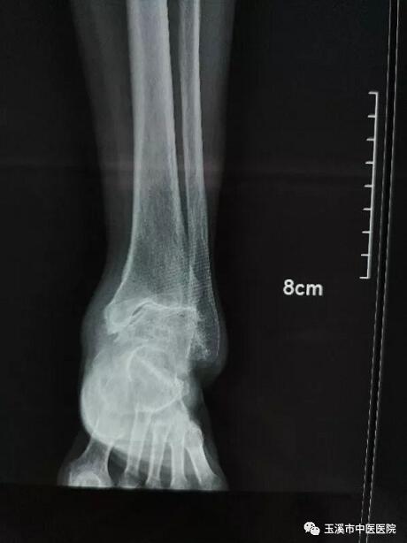 术前x光片(左踝关节正位)术前x光片(左踝关节侧位)术后x光片(左踝关节